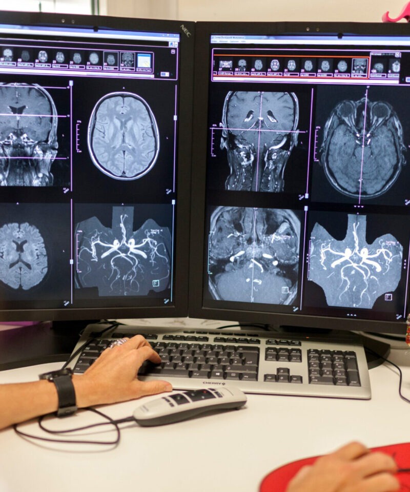 CT/Angiografiebilder zur Schlaganfalldiagnostik